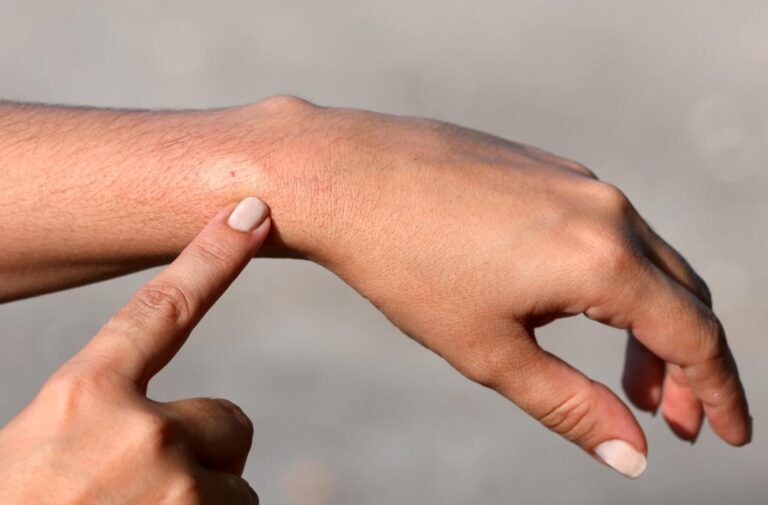 Stop Itching From Bee And Fire Ant Stings